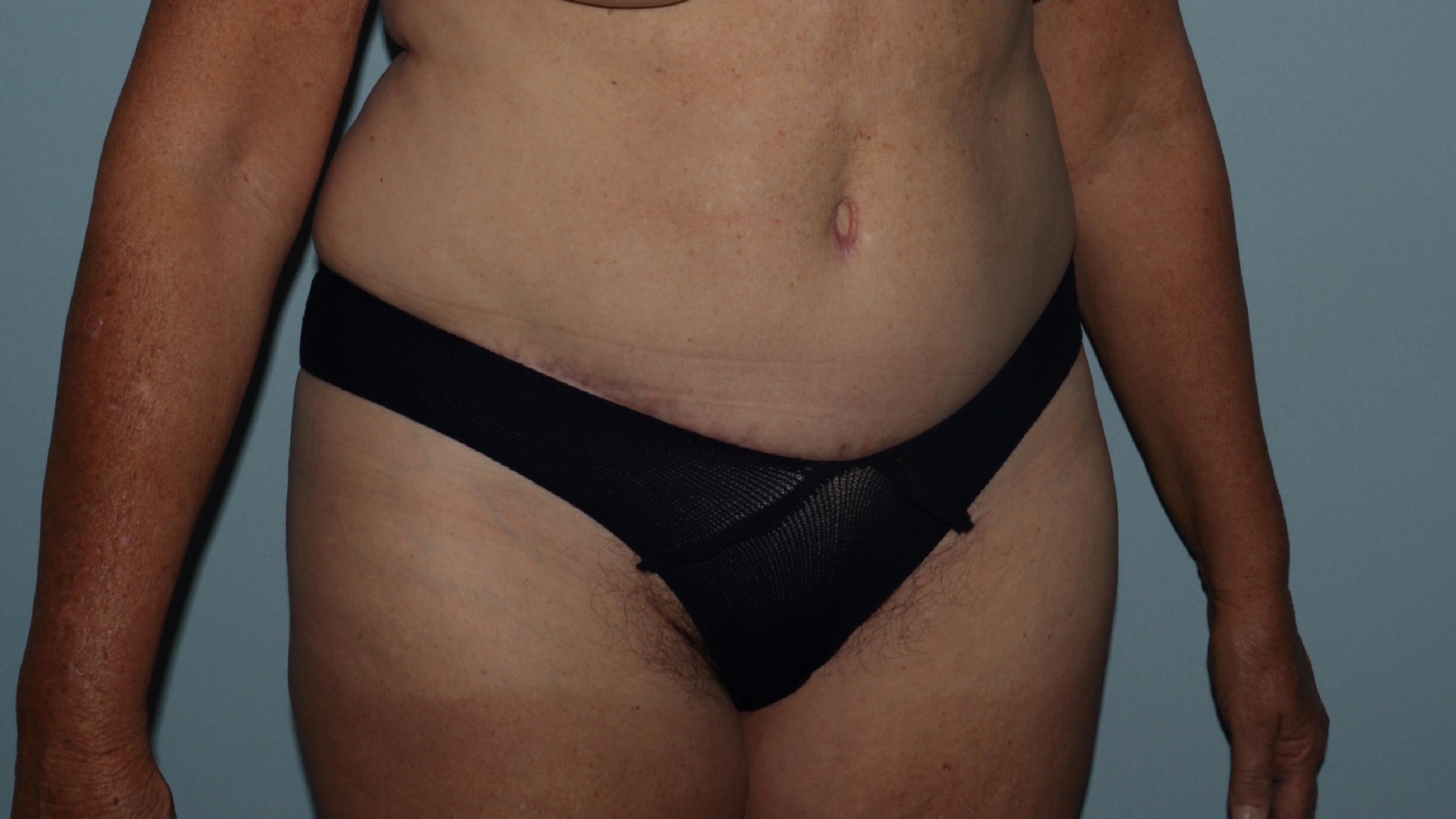 Oblique abdomen postop